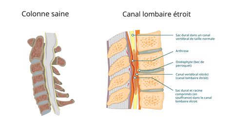 Canal Lombaire Troit Diagnostic Sympt Mes Et Chirurgie