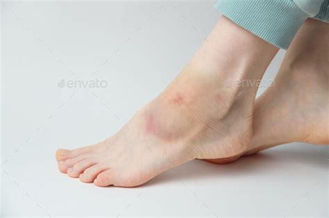 Sprained Ankle With Bruise And Swelling On A Female Left Foot On White