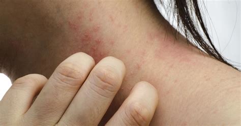 Heat Rash Symptoms Causes Treatments