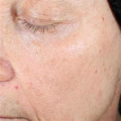 Laser Skin Photorejuvenation Treatment Ottawa Natural Sole Medi Spa