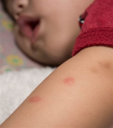 How To Treat And Prevent Mosquito Bites In Babies