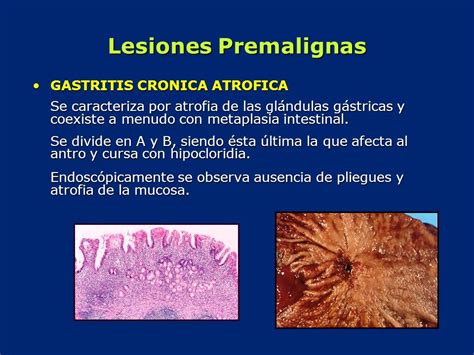 Gastritis (acute and chronic) is inflammation of the stomach lining. La gastritis: causas, síntomas y remedios naturales para ...