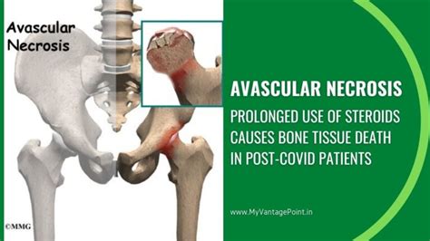 Avascular Necrosis Next Debilitating Condition Among Post Covid Patients