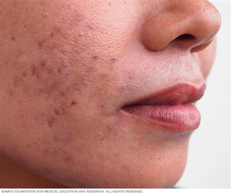 Acne Disease Reference Guide Drugs Com