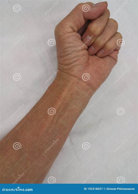 Red Rash On The Arms Stock Photography 104372870