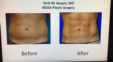A Liposuction Procedure Promises 6 Pack Abs Without Lifting A Finger Business Insider