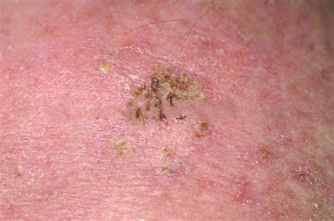Download Free Software Scaly Patch Of Skin On Scalp Peermediaget