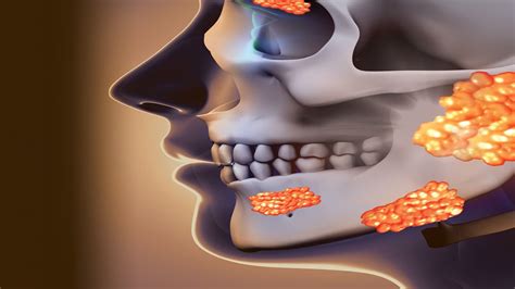 Treatment Approaches For Patients With Sjögrens Syndrome Decisions