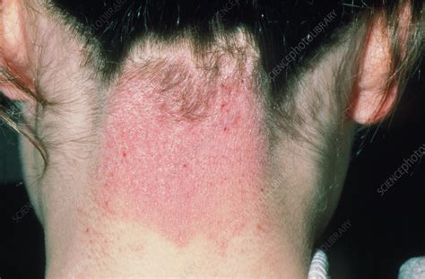 Eczema On The Back Of The Neck In A Girl Stock Image M1500111