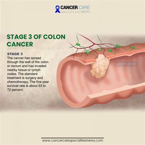 Stage 3 Of Colon Cancer Cancer Care Center Uae