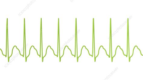 Atrial Flutter Abnormal Heartbeat Rhythm Illustration Stock Image