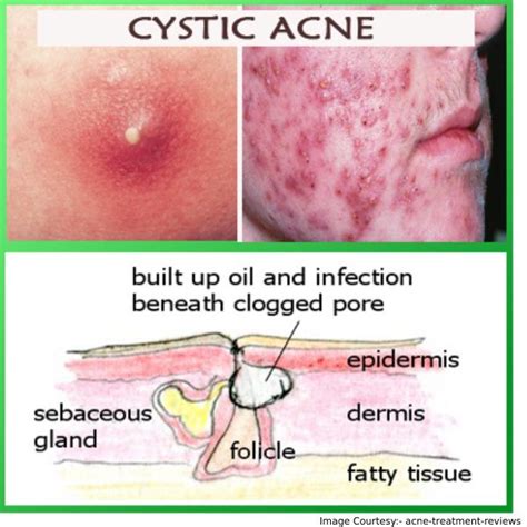 What Causes Cystic Acne Understand The Causes And The Treatment