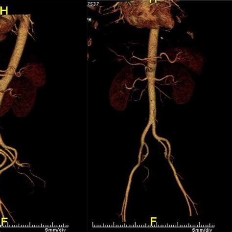 Ct Angiogram Of Abdominal Aorta Sagittal Plane On The Left And Coronal