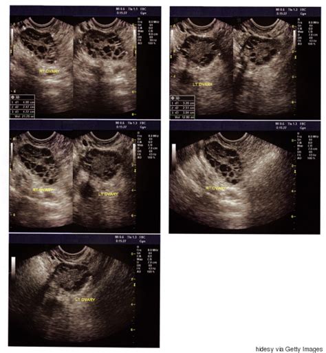 Just having ovarian cysts isn't enough for a diagnosis. What To Do If You've Been Diagnosed With PCOS