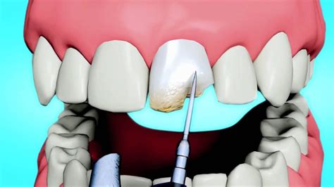 Dental Bonding Vs Dental Veneers Orlando Cosmetic Dentist Dr Paul