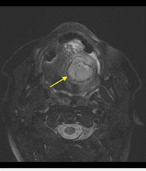 Axial Fat Suppressed T2 Weighted Magnetic Resonance Image Of The Neck