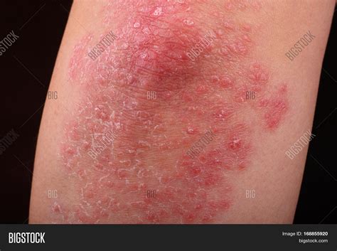 Psoriasis On Elbow Image And Photo Free Trial Bigstock