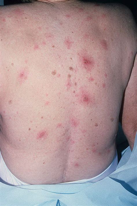 Early stages of herpes pictures. Herpes on Back Pictures - 18 Photos & Images / illnessee.com
