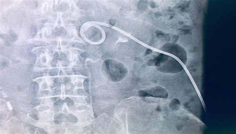 Pcnl Nephrostomy Tube Placement For Kidney Stones Backtable Urology