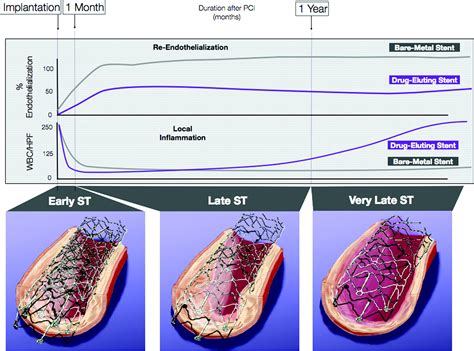 Off Label Use And The Spectre Of Drug Eluting Stent Thrombosis