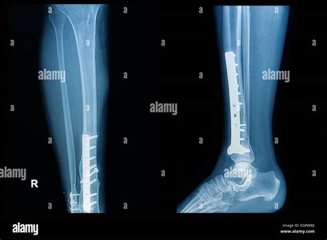 X Ray Image Of Fracture Leg Tibia With Implant Plate And Screw Stock
