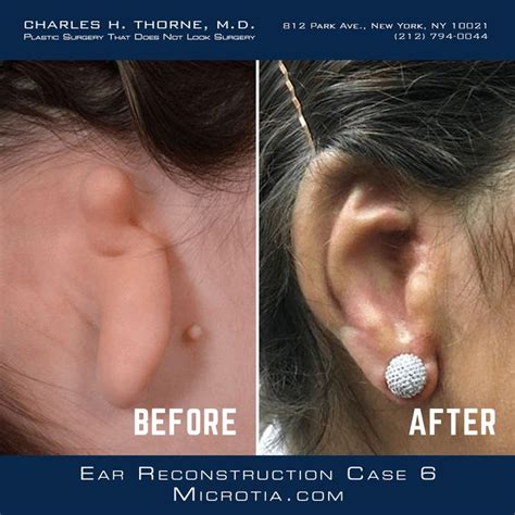 Microtia Ear Reconstruction Case Before And After Https Microtia Com