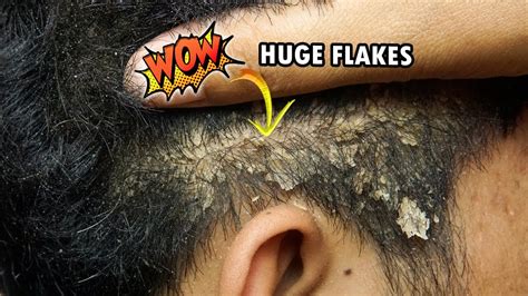 Huge Flakes Psoriasis Scratching Dandruff Around Ear 436 Youtube