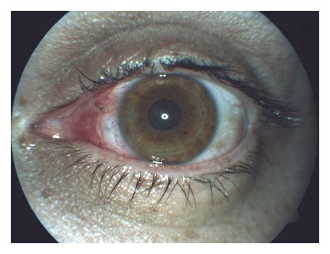 Penetrating Fish Hook Ocular Injury Management Of An