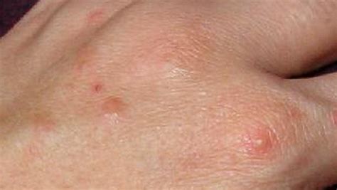 Dyshidrotic Eczema Hand Dorothee Padraig South West Skin Health Care
