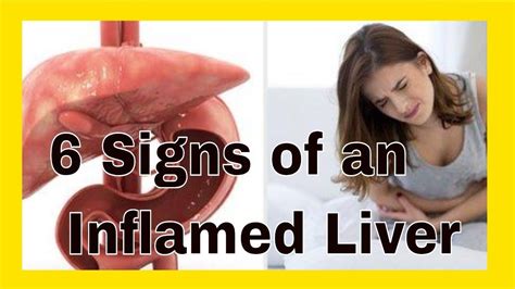 6 Signs Of An Inflamed Liver Enlarged Liver Enlarged Liver Remedies