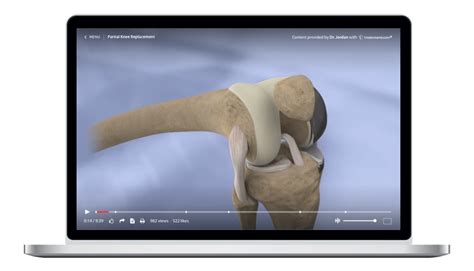 Partial Knee Replacement Animation