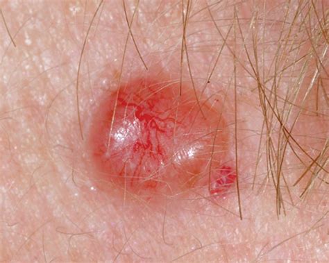 Red Skin Cancer Lesions