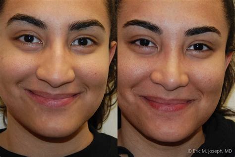 Eric M Joseph Md Rhinoplasty Before And After Nasal Hump Reduction