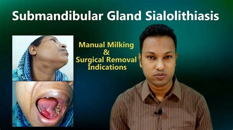 Salivary Gland Stone Or Sialolith Submandibular Gland Involvement