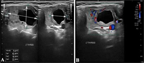 Ultrasound Of Left Thyroid Lobe Showing A Complex Nodule Download Scientific
