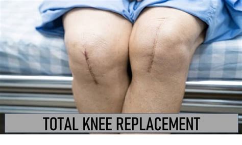 Total Knee Replacement Exercises Total Knee Replacement Recovery