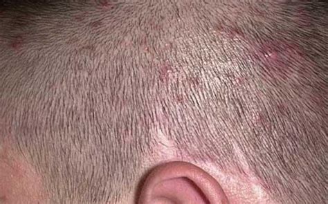 Small Red Itchy Pimples On Scalp Cause And Treatment Skincarederm