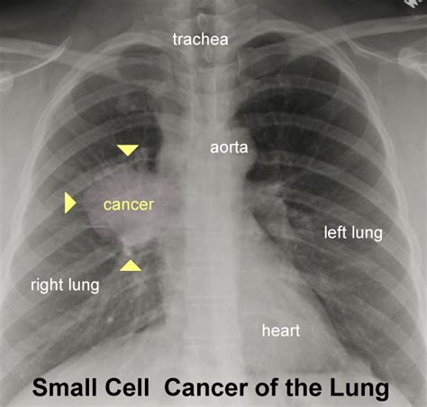 Small Cell Lung Cancer Chest X Ray