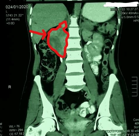 Cureus Retroperitoneal Ganglioneuroma In A Patient Presenting With