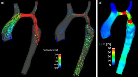 A Flow Patterns In A Hypoplastic Aortic Arch Left Systole Right