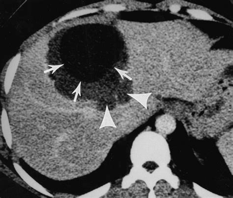 Echinococcus Granulosus Revisited Radiologic Patterns Seen In Pediatric