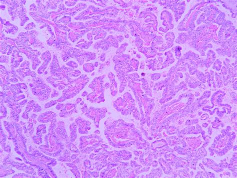 Papillary Carcinoma Thyroid Histopathologyguru