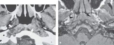 Nasopharynx Malignant Tumors Radiology Key