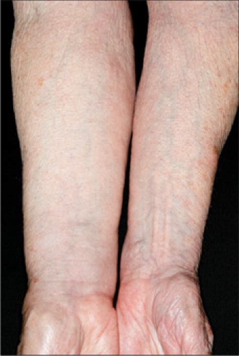 Arm Lymphoedema After Breast Cancer The Lancet Oncology