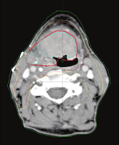 Target Volume Contouring In A Patient With Head And Neck Cancer Base