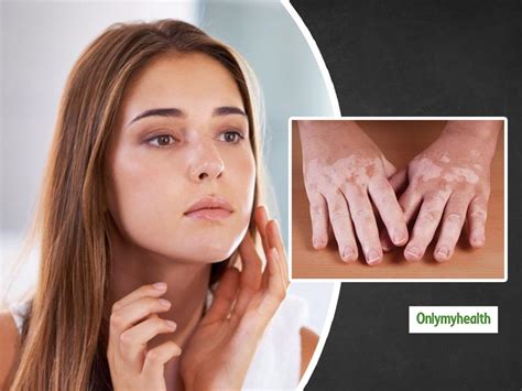Learn About Different Types Of Skin Pigment Disorders And