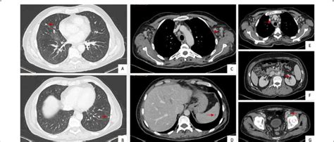 Disseminated Kaposi Sarcoma Revealed By The Total Body Ct Scan