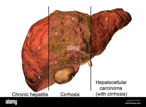 Human Liver Showing Stages Of Liver Disease And A Hepatitis Virus