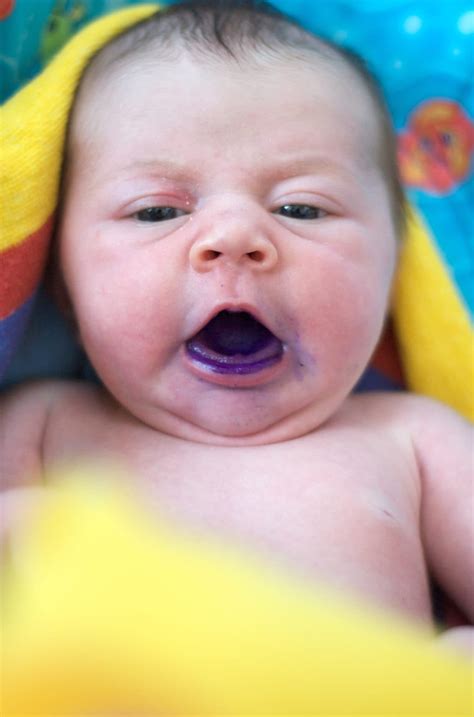 How To Get Rid Of Thrush On Tongue Baby Baby Viewer