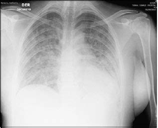 Embolismo pulmonar y trombosis venosa profunda. Disnea súbita después del terremoto